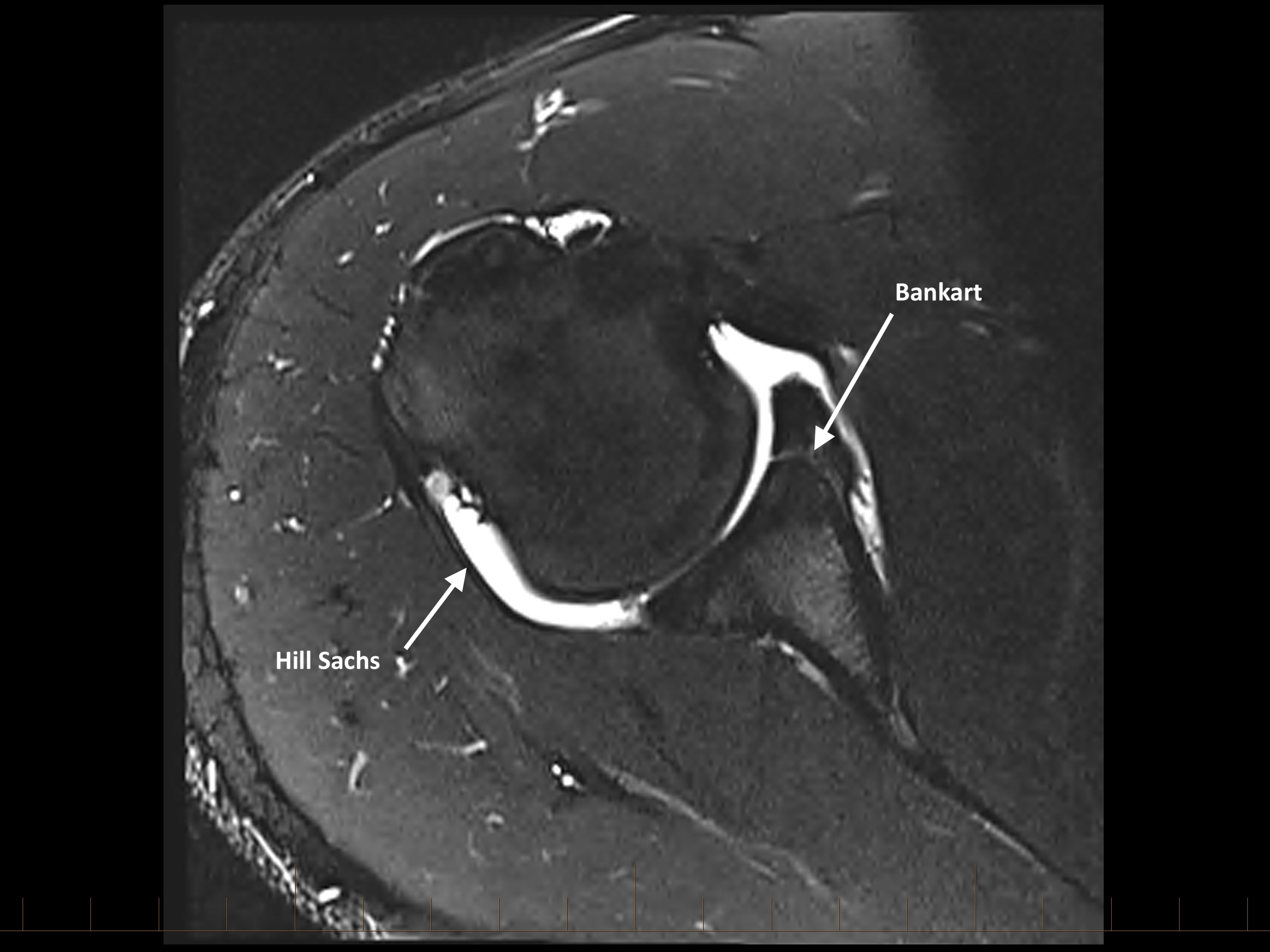 There is flattening of the posterosuperior humerus without marrow oedema (Hill-Sachs lesion)