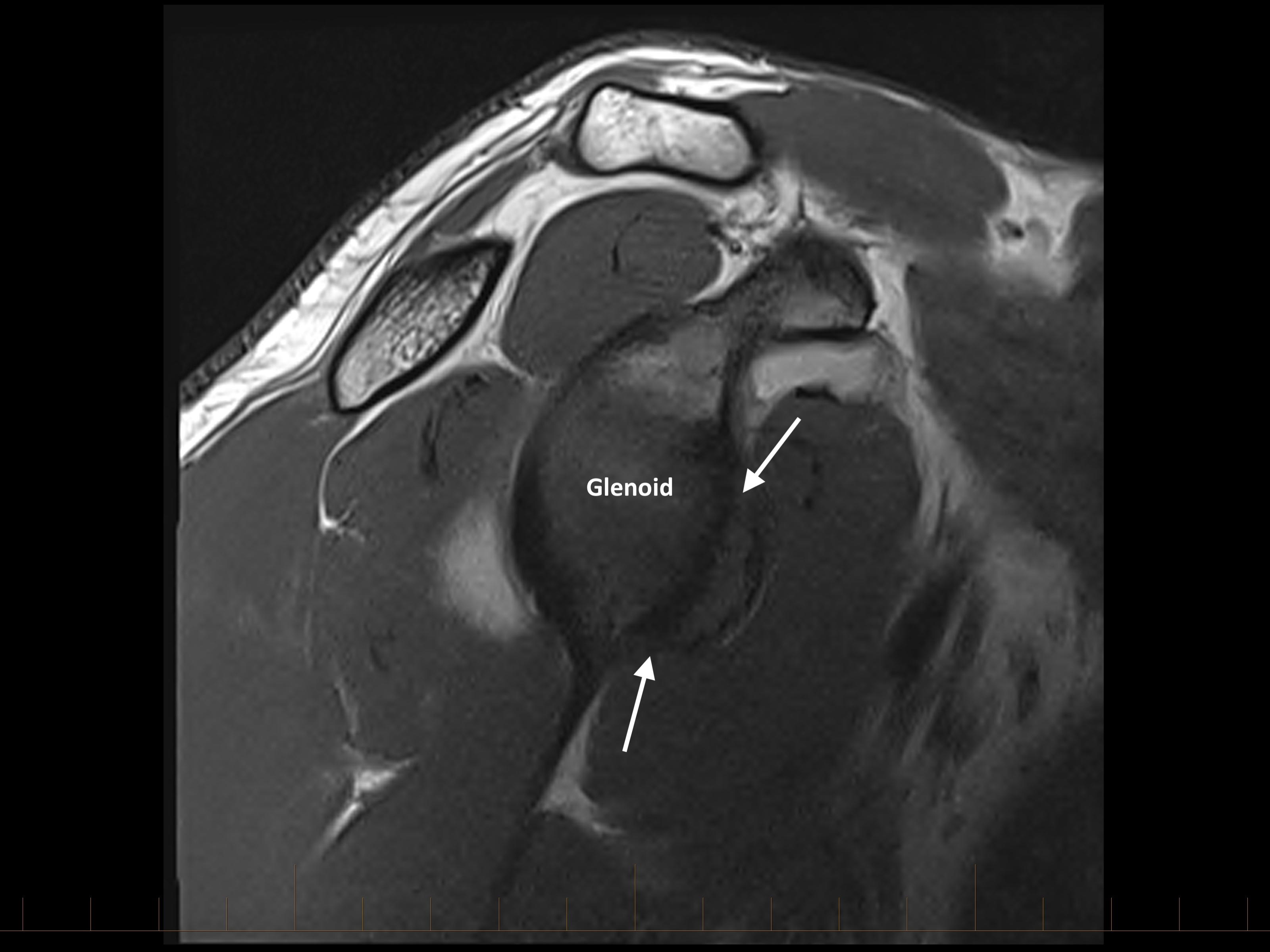 A large osseous Bankart fracture is seen on this sagittal image