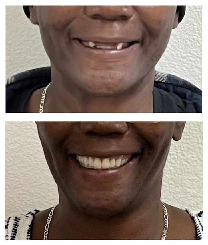 A before and after of a person with only two teeth and their smile later restored