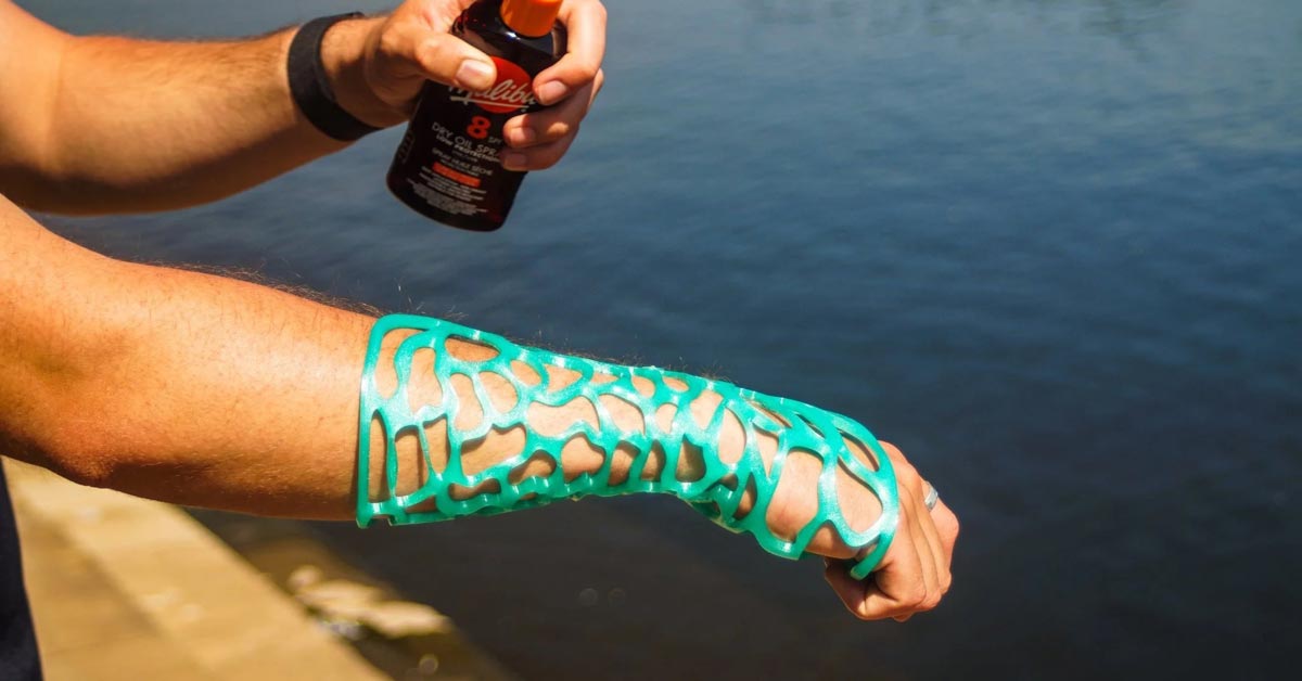 A person's forearm is covered in a 3D-printed turquoise cast