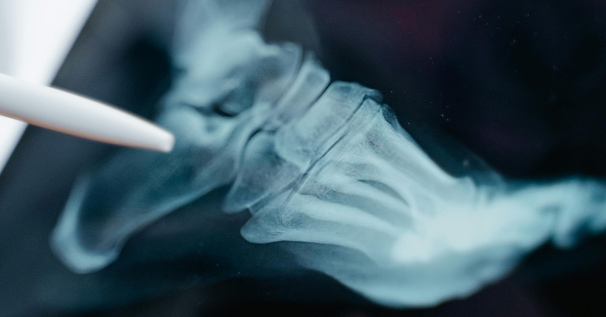 An x-ray of a foot