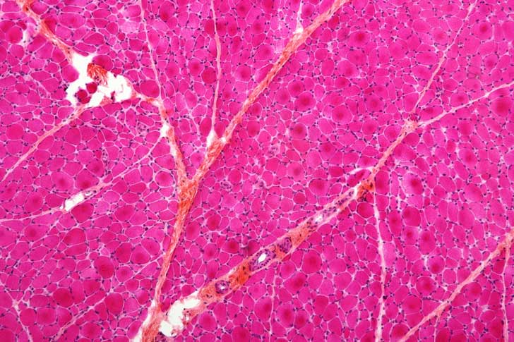 A muscle biopsy showing nerve atrophy