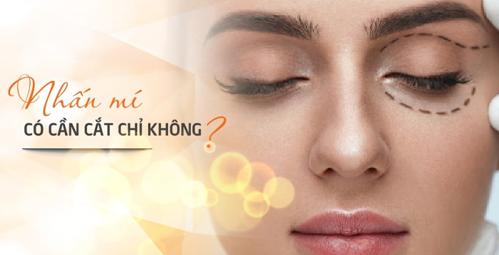 Nhấn mí mắt có cần cắt chỉ không?
