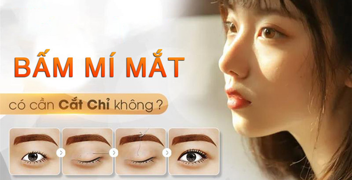 Nhấn mí mắt có cần cắt chỉ không?
