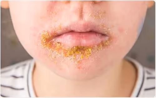 Entenda o que é Impetigo, quais os principais sintomas, causas e possíveis tratamentos  