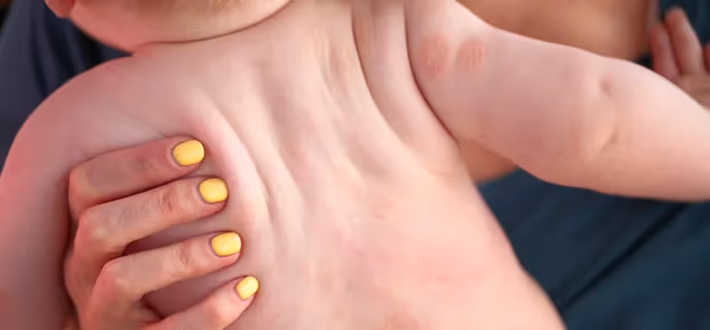 Você sabe diagnosticar e tratar a dermatite atópica?