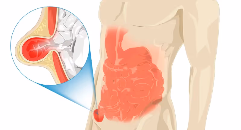 Hérnias da Região Inguinal, O que são, Sintomas e Como fazer o Diagnóstico