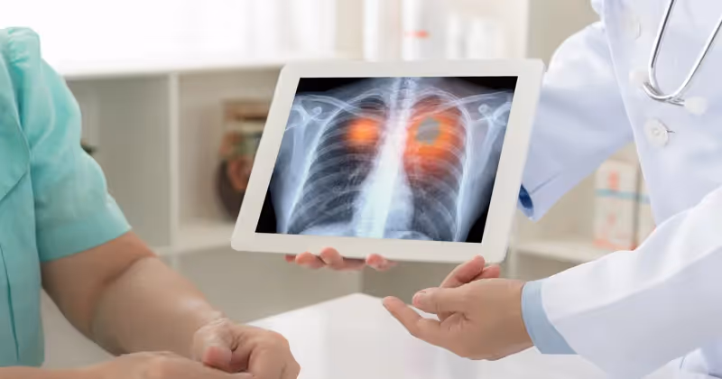Pneumonia Viral: O que é, Quais os Sintomas, Diagnóstico e Tratamento