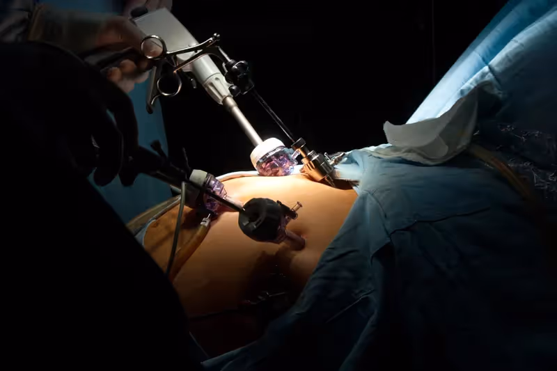 Bariátrica Bypass: Como funciona e técnica envolvida na cirurgia