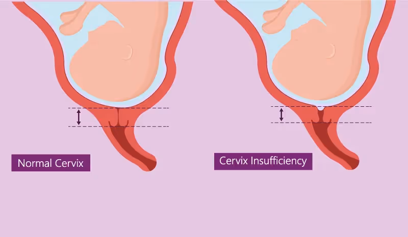 O que é a Incompetência Istmo Cervical, quais as causas e como tratar?