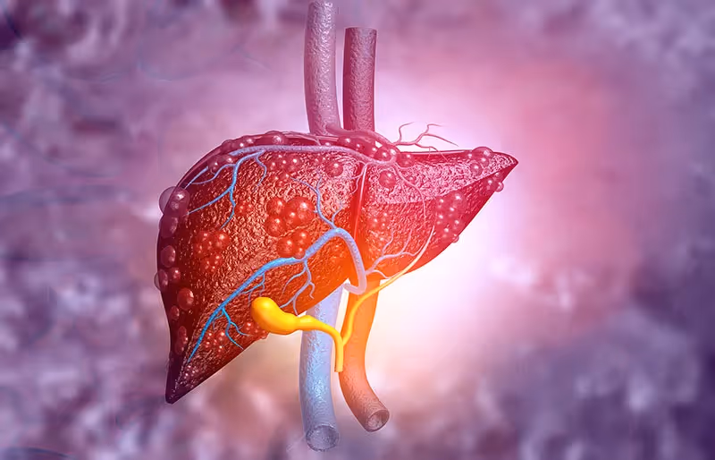 Doença Hepática Crônica: etiologias, complicações e tratamento