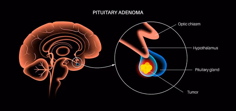 Acromegalia: o que é, quais as causas e como tratar
