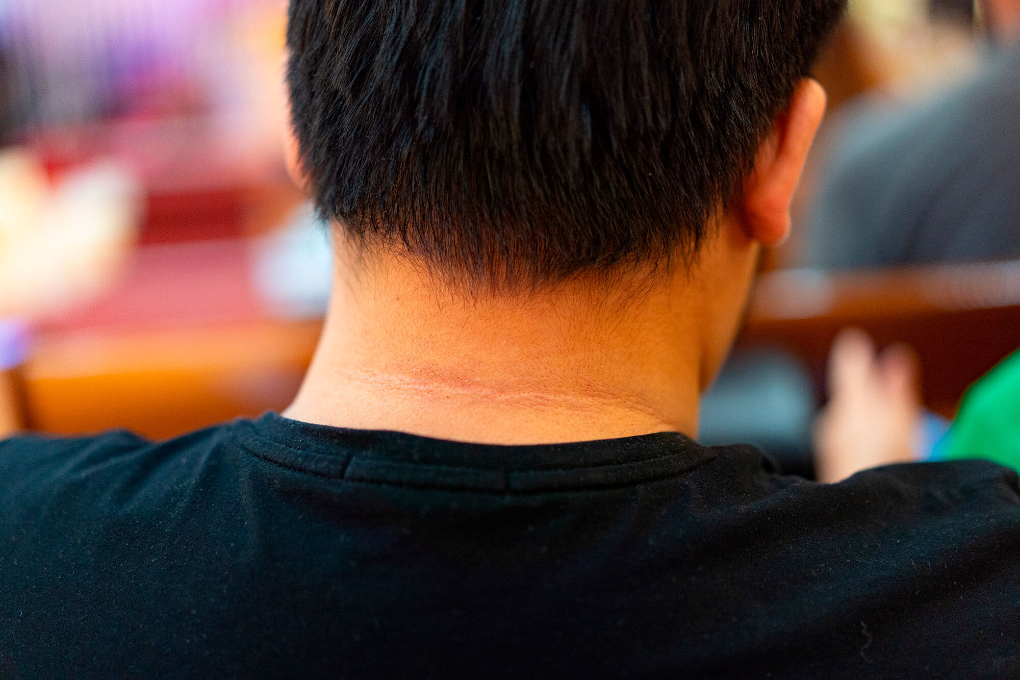 Acantose nigricans: o que é, fisiopatologia e tratamento