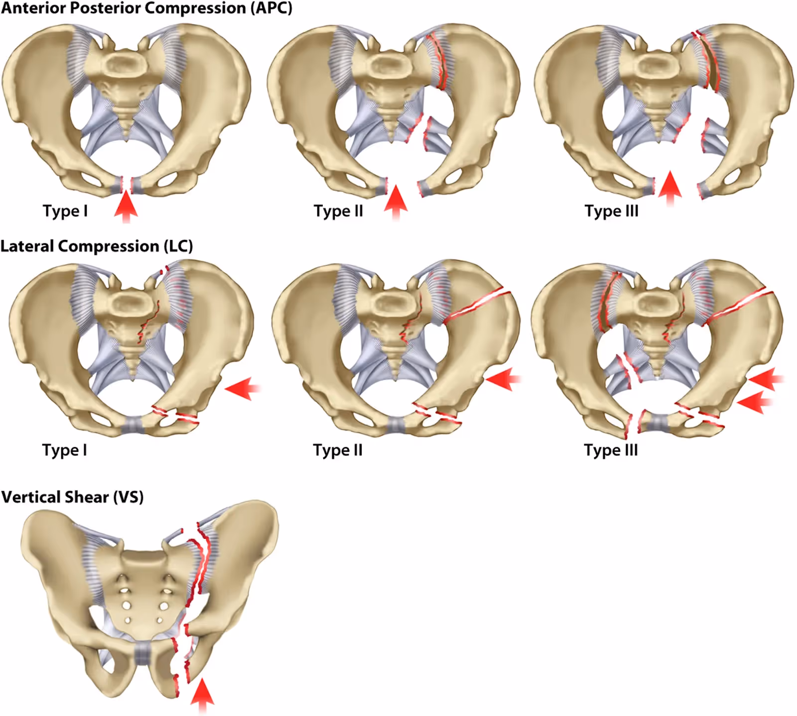 Classificação de Young Burgess para fratura de anel pélvico. Fonte:Timothy B.; Young and Burgess Classification Clinical Orthopaedics and Related Research, 2014
