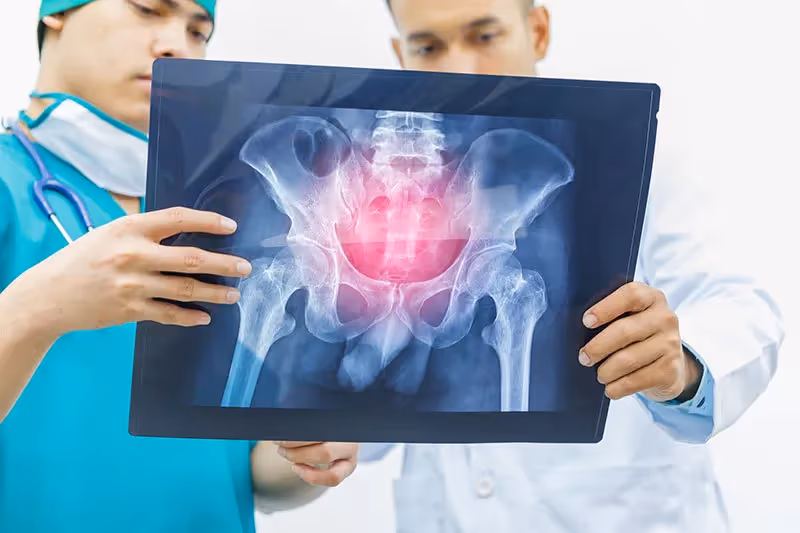 Fraturas Pélvicas: tipos, como diagnosticar e tratar