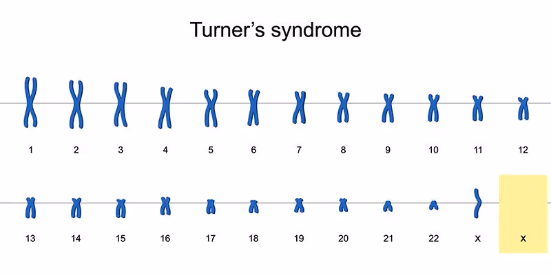 Síndrome de Turner: o que é, quais as principais características e como tratar
