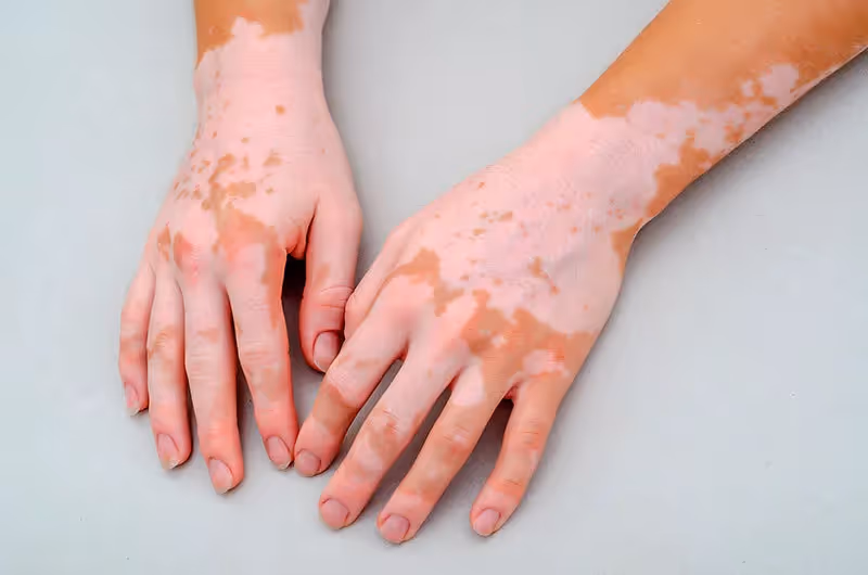 Vitiligo: o que é, como identificar e como tratar