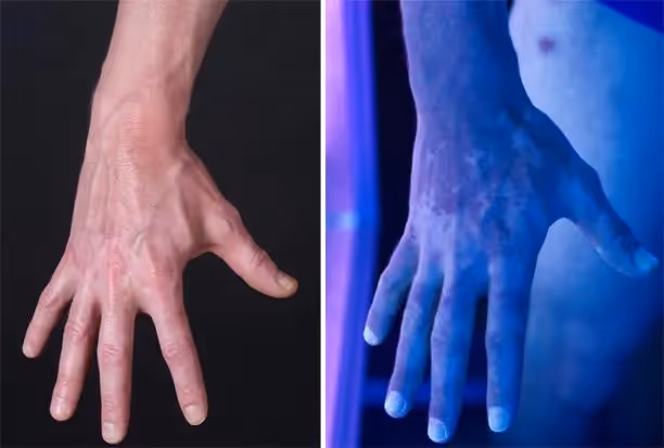 Vitiligo visto com mais facilidade por uma lâmpada de Wood. Fonte: Mdsmanuals