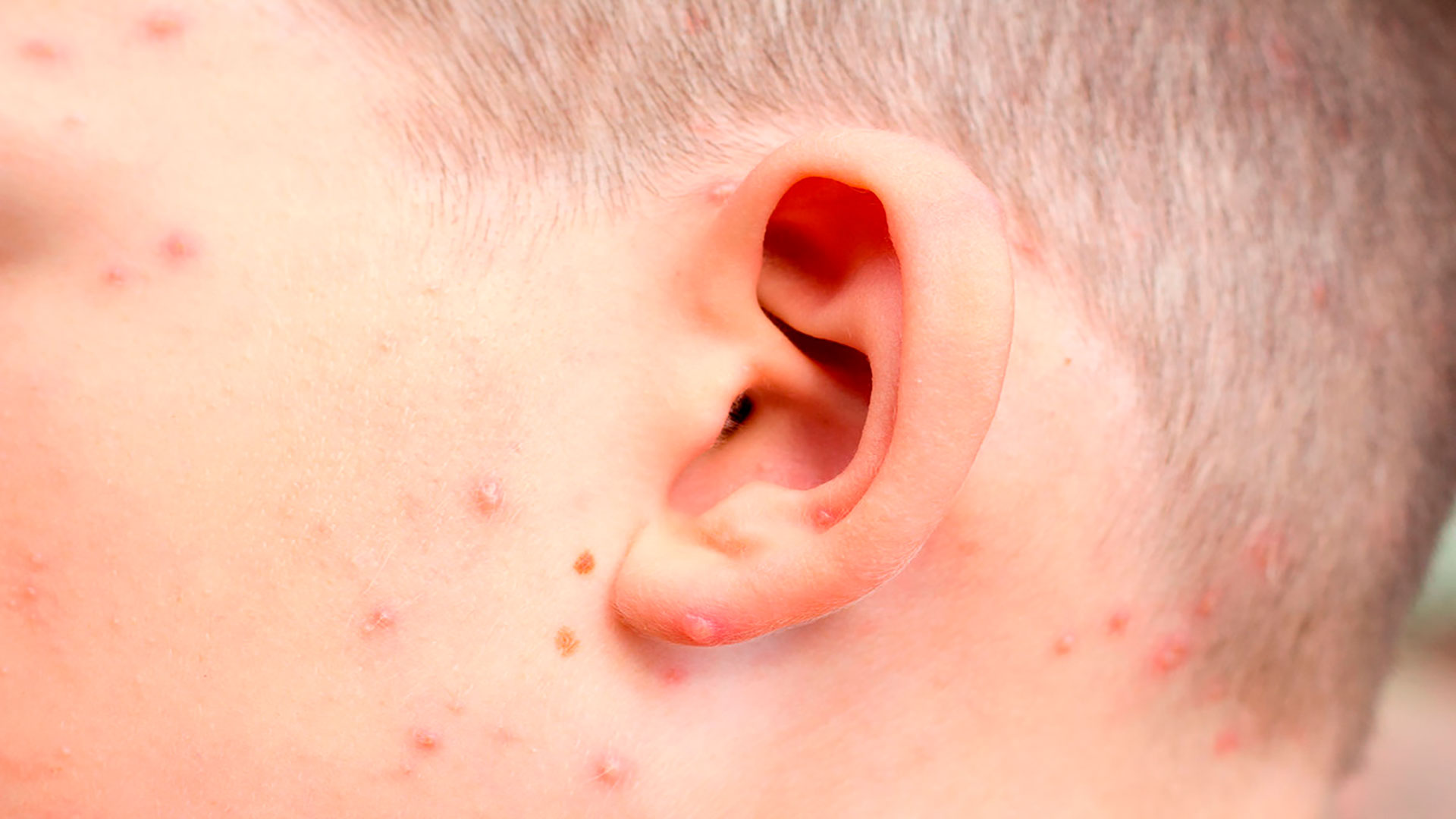 Síndrome de Ramsay Hunt: etiologia, quadro clínico e tratamento