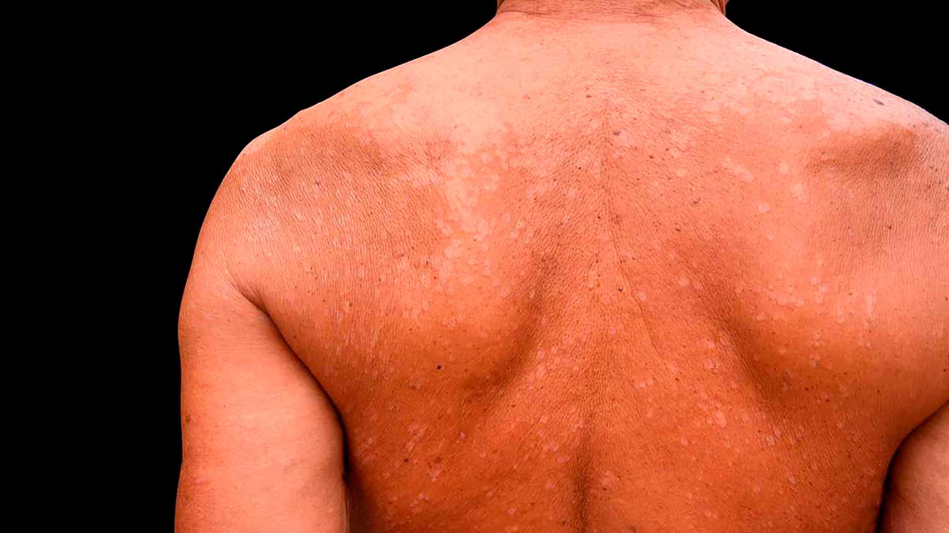 Pitiríase Versicolor: o que é, características clínicas e como tratar