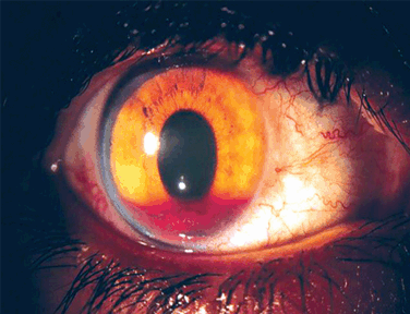 Hifema. Fonte: Hifema traumático: seguimento de um ano (2004) - Scielo; link da fonte: https://www.scielo.br/j/abo/a/DRZ9PPd8pVrjQXFQkY7kvYN/?lang=pt