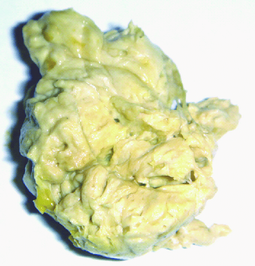 Acolia fecal: fezes esbranquiçadas. Fonte: ResearchGate link: https://www.researchgate.net/figure/Acholic-discolored-stool-of-a-baby-with-biliary-atresia_fig3_234100180