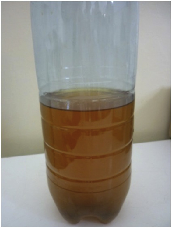 Colúria: urina acastanhada. Fonte: ScienceDirect link: https://www.sciencedirect.com/topics/medicine-and-dentistry/choluria