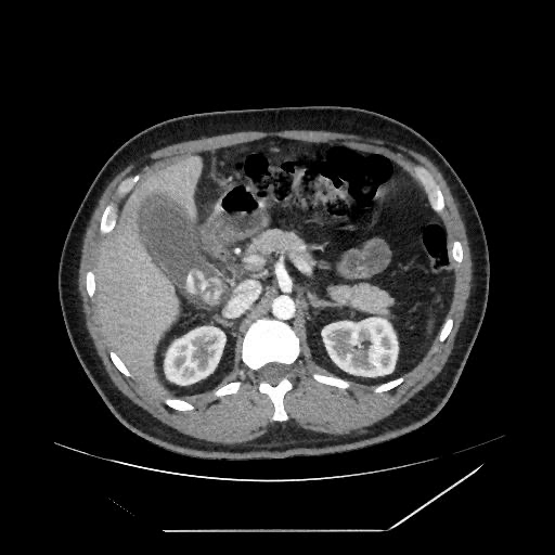 TC abdominal evidenciando Colecistite Aguda. Fonte: MedicinaNET