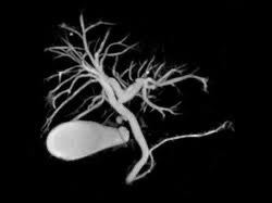 Colangioressonância Contrastada. Fonte: Rodriguez Radiologos