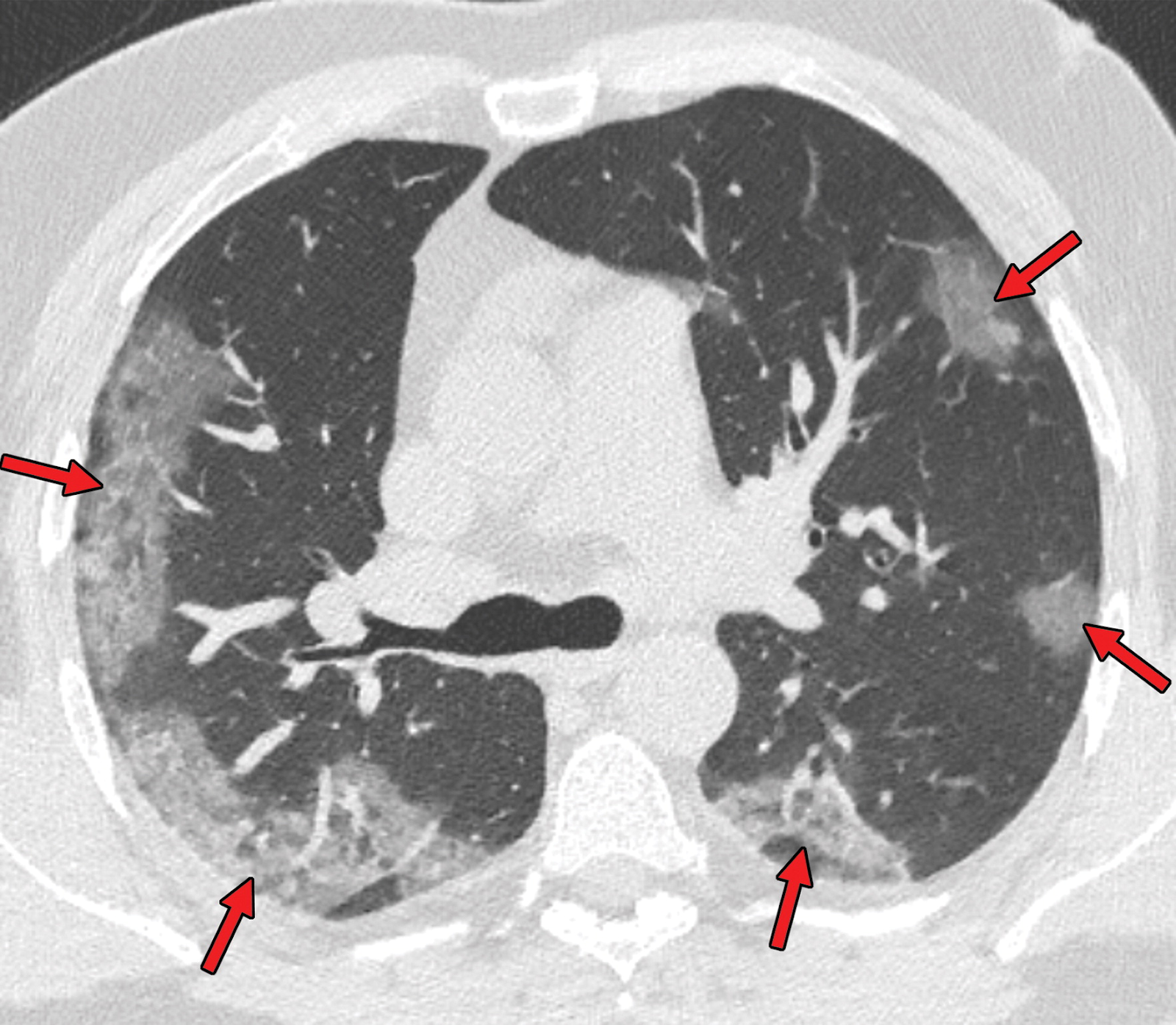 Padrão de vidro fosco periférico visto em TC de tórax de paciente com SRAG por COVID-19. Fonte: RadioGraphics
