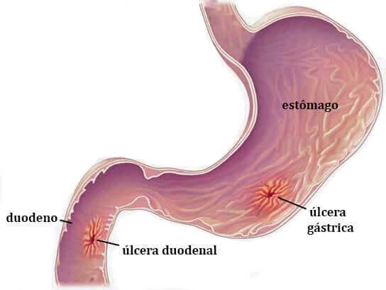 Úlcera gástrica e úlcera duodenal. Fonte: Dr Paulo Pitteli link: ‍https://drpaulopittelli.com.br/doencas-e-tratamentos/ulcera-gastrica-e-ulcera-duodenal/