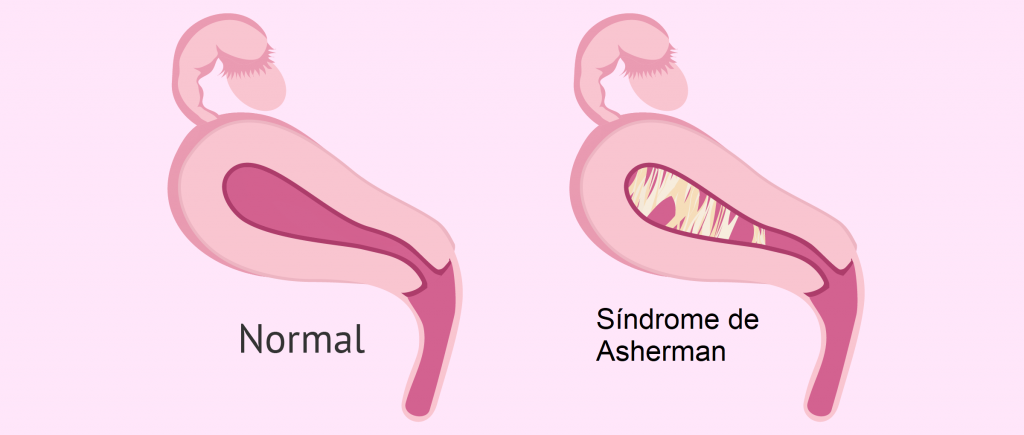 A síndrome de Asherman causa aderências intrauterinas chamadas de sinéquias, que podem lesar o endométrio e causar amenorreia. Fonte: Síndrome de Asherman: Tratamento, Diagnóstico, Tem cura? - Clinica Geral link: https://clinicagera.com.br/sindrome-de-asherman/