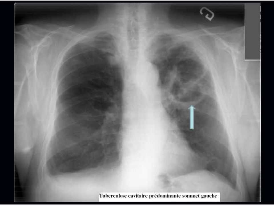 Caverna Pulmonar em pulmão esquerdo causada por Tuberculose. Fonte: Slide Player; link da fonte: https://slideplayer.com.br/amp/10777815/