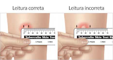 Demonstração do Teste Tuberculínico. É considerado como infectado pelo M. tuberculosis o paciente com enduração maior ou igual a 5 mm. Fonte: Biomedicina Padrão; link da fonte: https://www.biomedicinapadrao.com.br/2011/03/teste-tuberculinico-ppd.html