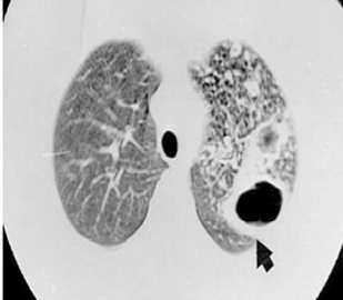 A Tomografia Computadorizada é um exame mais sensível, mas é indicada apenas caso o paciente apresente suspeita clínica e o Raio-X se apresente normal. Fonte: Inesul; link da fonte: https://www.inesul.edu.br/revista_saude/arquivos/arq-idvol_15_1351342268.pdf