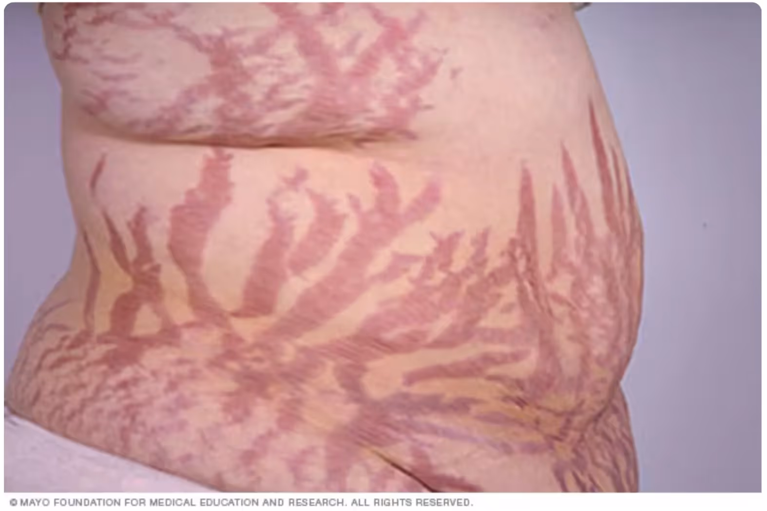 Estrias em paciente com Cushing. Fonte: Mayoclinic.org