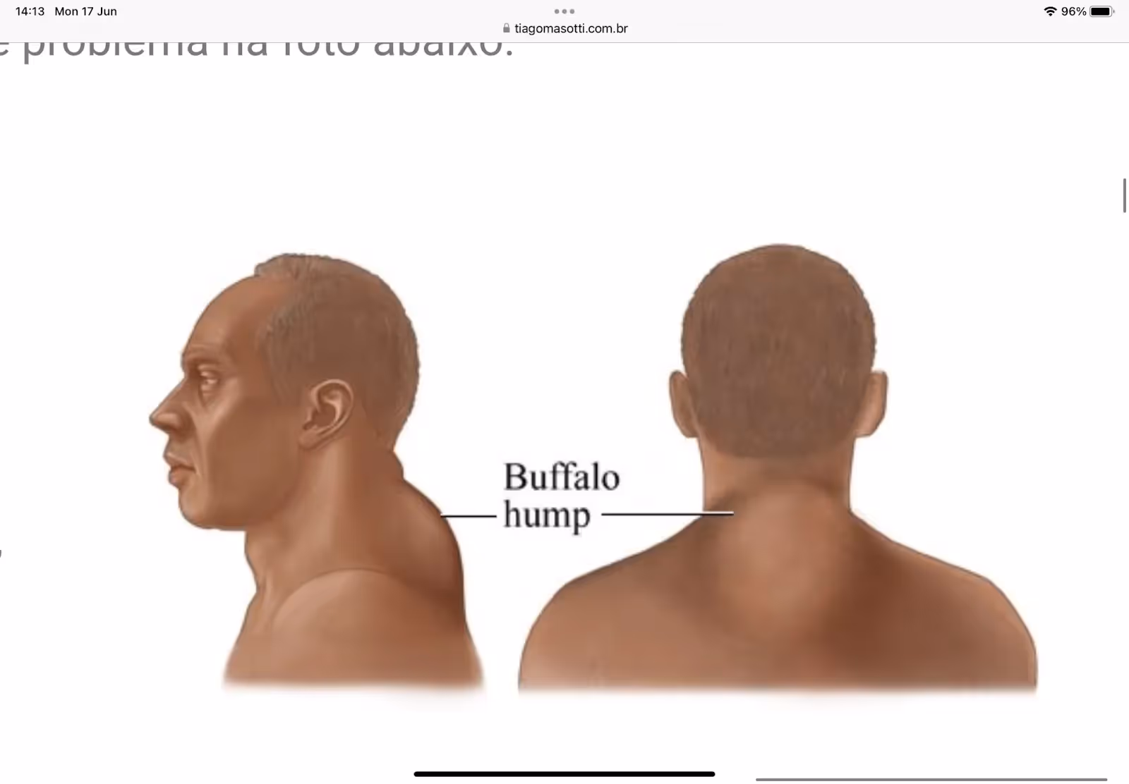 Acúmulo de gordura na região superior das costas, também chamada de Corcova de Búfalo. Fonte: Blog Dr. Tiago Masotti