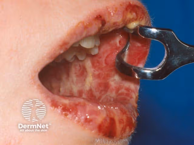 Pênfigo paraneoplásico. Fonte: DermNet