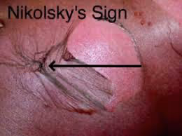 Sinal de Nikolsky. Fonte: MedSea