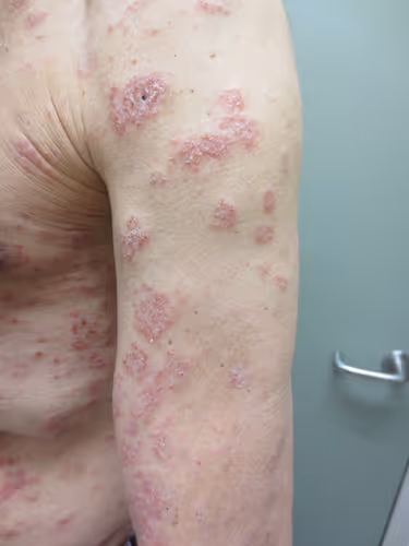 Pênfigo herpetiforme. Fonte: Wiley