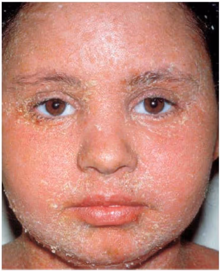 Pênfigo foliáceo. Fonte: Rivitti