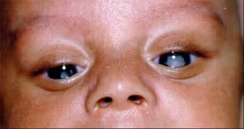 Presença de catarata, caracterizada por opacificação do cristalino. Fonte: Catarata Congênita - COHR Oftalmologia Itatiba