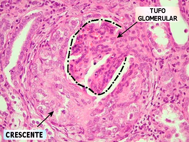 Lâmina histológica com crescentes epiteliais. Os crescentes são proliferações de células no folheto parietal da cápsula de Bowman, estimuladas pela deposição de fibrina. Fonte: Anatpat (http://anatpat.unicamp.br/lamuro3.html)