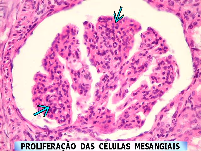 Lâmina histológica da glomerulonefrite proliferativa mesangial. Observe que os tufos glomerulares se “destacam” uns dos outros, formando “lobulações”. Além disso, observe a hipercelularidade
