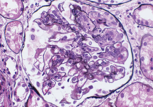 Lâmina histológica de nefrite lúpica na classe IV. Observe a distorção dos tufos devido a infiltração de células inflamatórias. E ainda, a presença de eosinófilos nos mesângios