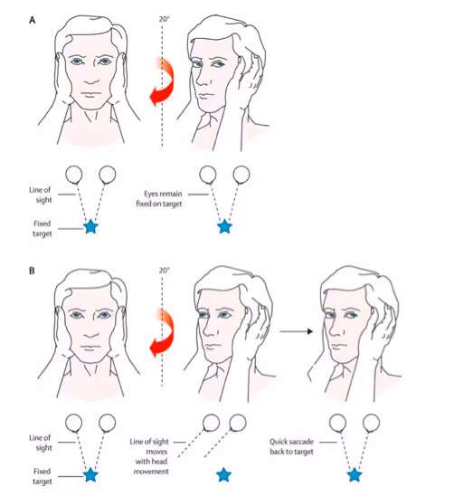 Esquematização da realização do head impulse positivo (A) e negativo (B). Fonte: NUEM Blog