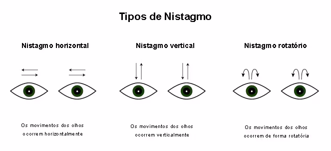 Tipos de Nistagmos. Fonte: Nistagmo - o que é, causas, tipos, sintomas olhos, tem cura?