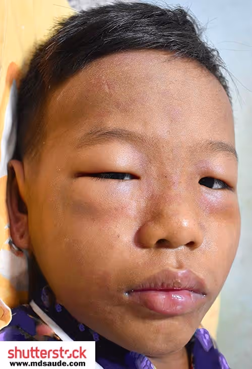 Edema facial típico da síndrome nefrótica. Fonte: Md.Saúde