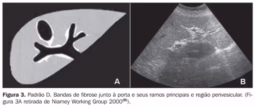 Representação da fibrose de Symmers (figura A), e ultrassom de veia porta (figura B). Aqui, é possível observar que a fibrose se apresenta ecogênica ao exame. Fonte: Reprodutibilidade da classificação ultra-sonográfica de Niamey na avaliação da fibrose periportal na esquistossomose mansônica (https://www.scielo.br/j/rb/a/t85Ft8xBQcx7xNSstBDLSpj/?lang=pt)