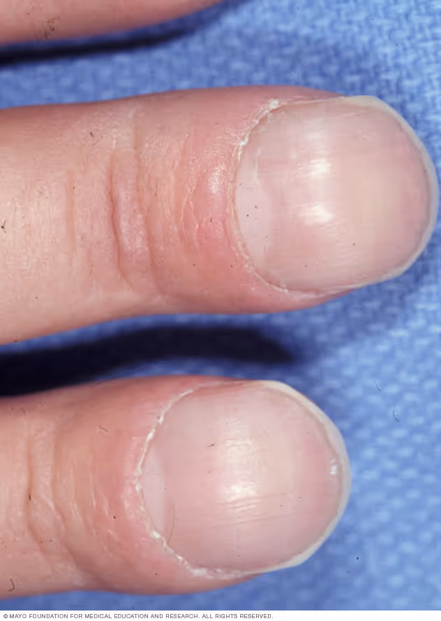 Imagem exemplificando o baqueteamento digital